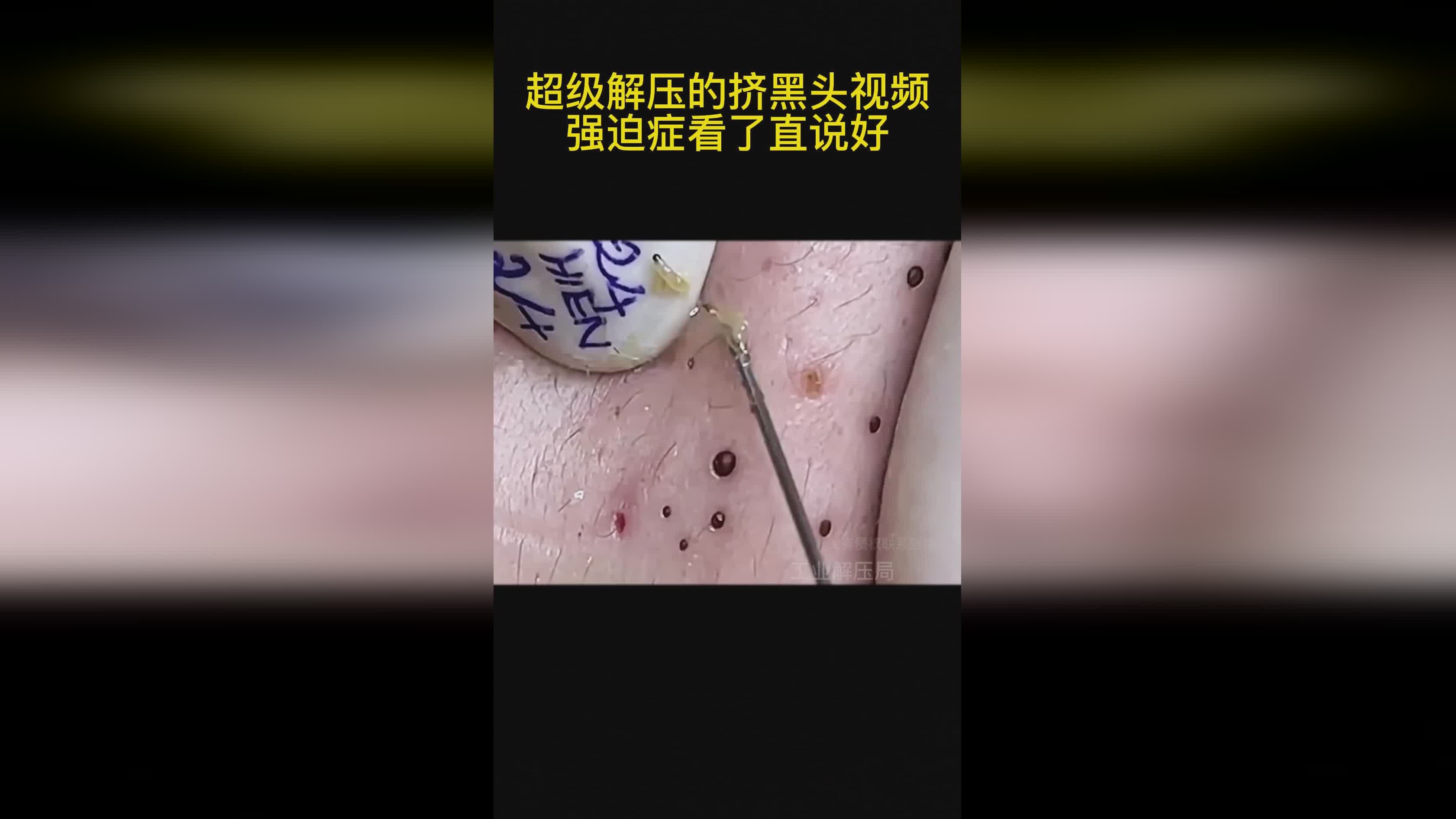 探索挤黑头最新视频，护肤的新视角